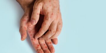 Mazelenepidemie treft Texas: meer dan 120 gevallen in weken