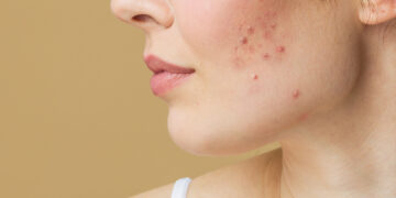Acne bestrijden: effectieve methoden en behandelingen