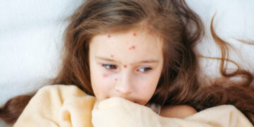 Vitamine A en maïsolie helpen bij genezing mazelen volgens Griekse arts