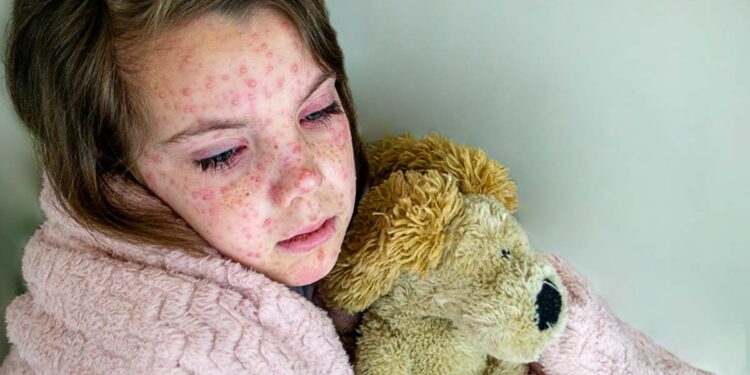 Mazelen uitbraak versnelt in Europa: Griekse gegevens