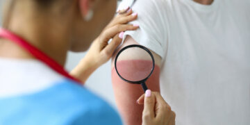 Kunstmatige intelligentie helpt bij sluiten van wonden na verbranding