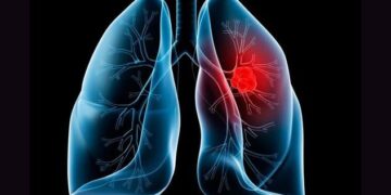 Doorbraak: Mensen ontvangen succesvolle longtransplantatie van varkens.