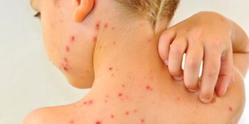 Nieuw: Waterpokkenvaccinatie in standaardinenting voor baby’s volgend jaar