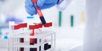 Nieuwe bloedtest voor Alzheimer’s diagnose getest op Britse patiënten.