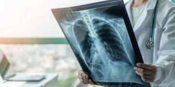 Tuberculose: de dodelijkste ziekte met 1,23 miljoen sterfgevallen in 2024