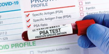 Nadering van prostaatkankerscreening in NHS-programma vandaag.