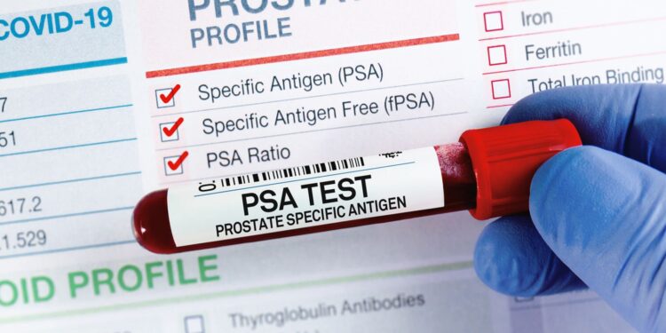 Nadering van prostaatkankerscreening in NHS-programma vandaag.