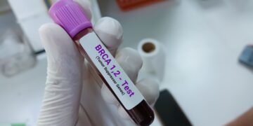 Waarom prostaatkanker geen nationale screening heeft