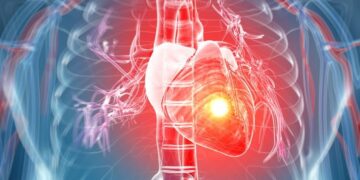 Genezing na hartaanval met cardiale pleister