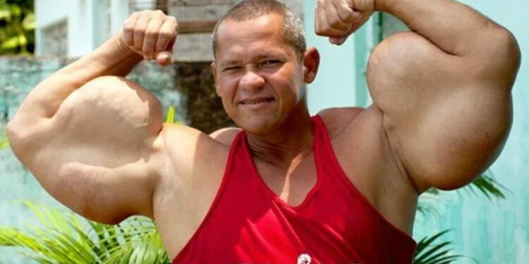 Braziliaanse ‘Popeye’ overlijdt op 55-jarige leeftijd door olie-injecties