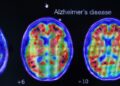 Eenvoudige thuis-test voorspelt risico op Alzheimer, zegt studie.