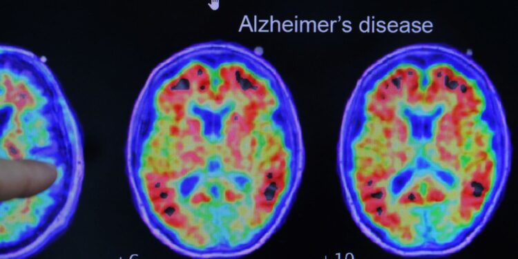 Eenvoudige thuis-test voorspelt risico op Alzheimer, zegt studie.