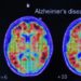 Eenvoudige thuis-test voorspelt risico op Alzheimer, zegt studie.