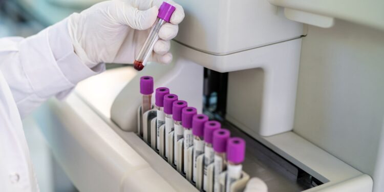 Bloedtest kan tekenen van Alzheimer decennia vóór symptomen detecteren