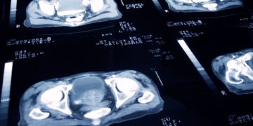 Gemiste kans: overheid wijst massale screening prostaatkanker af.